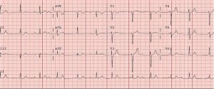 Figure 2. Admission electrocardiogram demonstrating complete heart block