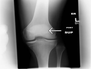 Figure 2. Anterior-posterior radiograph showing widening of the left proximal tibiofibular joint