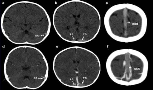 Hyperdense Cerebral Sinus Vein Thrombosis on Computed Tomography