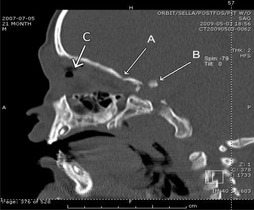 Complicated Orbital Apex Fracture in a Child with a Mild Eye Injury