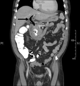Figure 1. Coronal section of abdominal computed tomography scan with contrast shows presence of pneumobilia (arrow).