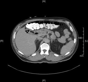 Figure 2. Transverse section of abdominal computed tomography scan with contrast shows gallbladder adherent to transverse colon (arrowhead).