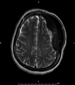 Figure 1. Moderate mass effect with 5mm midline shift to the right on the underlying left cerebral hemisphere.