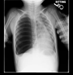Figure 1. Initial chest radiograph showing a massive right pneumothorax with mediastinal shift.