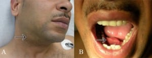 Figure 1. A) Right submandibular mass (arrow) and B) soft-tissue, sublingual mass (arrow).