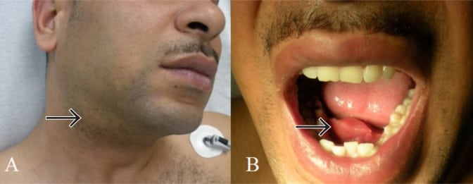 Ultrasound Diagnosis of Acute Neck Pain and Swelling