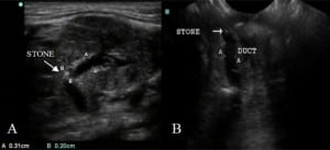 Figure 2. A) Ultrasound of submandibular gland depicting intraductal calculus with dilated duct. B) Sublingual ultrasound (using the endocavitary transducer) showing a second intraductal calculus with continued ductal dilatation.