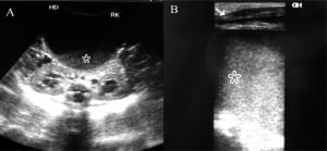 Figure 2. Axial Ultrasound (A and B) demonstrates a large abdomino-pelvic mass lesion with mobile internal debris (asterisk). Mass is causing bilateral moderate hydronephrosis. Note the presence of collapsed bladder anteriorly (arrow).