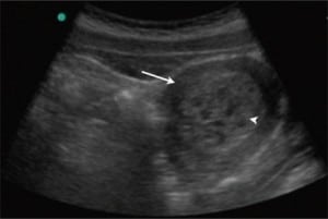 Figure. A transabdominal ultrasound of the pelvis revealing a uterus (arrow) with multiple cystic areas within an enlarged echogenic endometrial cavity (arrowhead).