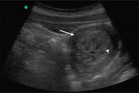 Molar Pregnancy