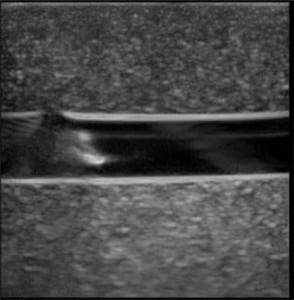 Figure 5. Long-axis image of the Blue Phantom™ rubber matrix, simulated vessel, and needle tip after the initial needle puncture.