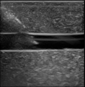 Figure 6. Long-axis image of the Blue Phantom™rubber matrix, simulated vessel, and needle tip after 1,000 needle punctures in a 1 cm2 area at a 45° angle.