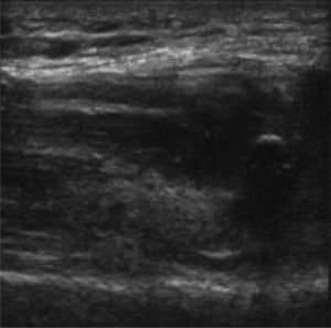 Figure 1. Sagittal view of right quadriceps tendon rupture