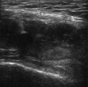 Figure 2. Transverse view of right quadriceps tendon rupture