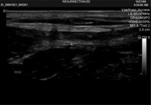 Figure 2. Inguinal ligament (IL).