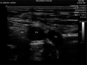 Figure 3a. Ultrasound image of femoral vein (FV), artery (FA), nerve (FN) and inguinal ligament (IL).