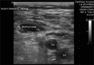 Figure 5. Ultrasound image of femoral vein (FV), artery (FA), nerve (FN) and inguinal ligament (IL) and expanding bupivacaine around FN.