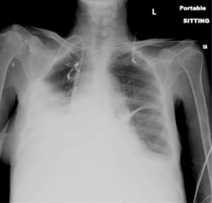 Figure 1. Portable upright chest radiograph reveals bilateral pleural effusion.