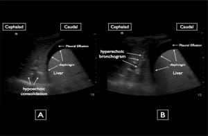 Figure 2. A) Ultrasound of the right lower thorax. B) Ultrasound of the right lower thorax.