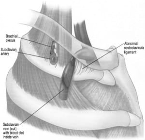 Figure 2. Abnormal lateral insertion of the costoclavicular ligament in Paget-Schroetter syndrome. 