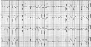 Figure 1. Initial electrocardiogram demonstrated frequent preventricular contractions which progressed to runs of sustained ventricular tachycardia.