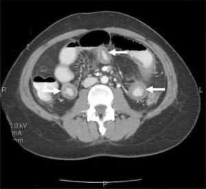 Figure 1. Computed tomography revealing small bowel mural thickening and submucosal edema (arrows).