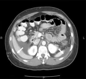 Figure 2. More cephalad section of the same computed tomography revealing areas of dependant ascites (arrows).