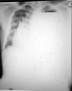 Figure 1. Chest radiograph of patient with progressive dyspnea