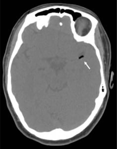 Figure 1. Computed tomography demonstrating an air embolism in the left middle cerebral artery distribution (arrow)
