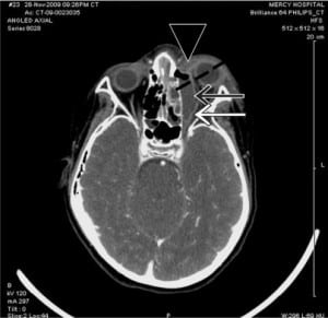 Figure 1. Axial view of contrast-enhanced CT scan demonstrating (black arrow) extraconal orbital subperiosteal abscess with air-fluid collection along the medial and anterior walls of the maxillary sinus with (white arrow) associated lateral displacement of the left medial and inferior recti, (arrowhead) left preseptal cellulitis with proptosis, (dotted line) left maxillary and ethmoid sinusitis.