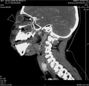 Figure 2. Sagittal view of contrast-enhanced CT scan demonstrating (black arrow) extraconal orbital subperiosteal abscess with air-fluid collection along the medial and anterior walls of the maxillary sinus with (white arrow) associated lateral displacement of the left medial and inferior recti, (arrowhead) left preseptal cellulitis with proptosis, (dotted line) left maxillary and ethmoid sinusitis.