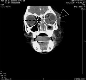 Figure 3. Coronal view of contrast-enhanced CT scan demonstrating (black arrow) extraconal orbital subperiosteal abscess with air-fluid collection along the medial and anterior walls of the maxillary sinus with (white arrow) associated lateral displacement of the left medial and inferior recti, (arrowhead) left preseptal cellulitis with proptosis, (dotted line) left maxillary and ethmoid sinusitis.