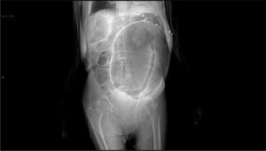 Figure 2. Anteroposterior scout film of computed tomography abdomen