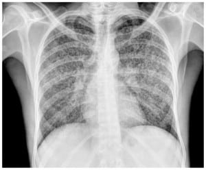 Figure 1. Bilateral micronodular interstitial pattern indicative of miliary tuberculosis.