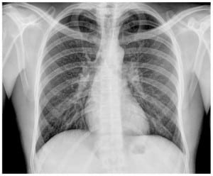 Figure 2. Resolution of bilateral micronodular interstitial pattern after one month of treatment