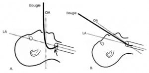 Figure 4. The arrow in diagram A demonstrates the location of potential resistance to glottic entry when using a bougie curved for GVL use.