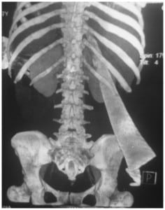 Figure. A reconstructed image of computed tomography of the thorax and abdomen with the patient in prone position, showing the piece of glass passing through the right kidney.