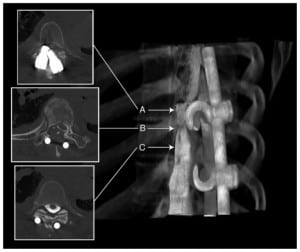 Figure 2. Two-dimensional computed tomography myelogram and corresponding 3D reconstruction of the injured spinal cord from the identical data set. Physical examination of the patient confirmed complaints with findings pathognomonic for Brown-Sequard type spinal cord compression or hemisection (A). Compression of the thecal sac is definitively demonstrated in high resolution (B). The normal thecal sac is also demonstrated (C).