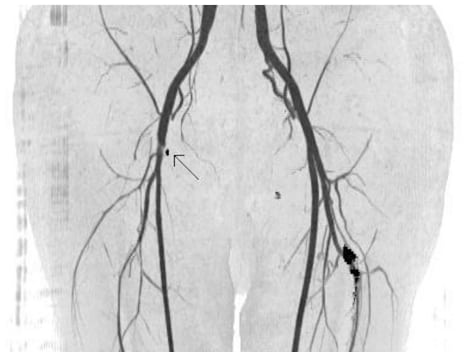 Iatrogenic Claudication from a Vascular Closure Device after Cardiac Catheterization