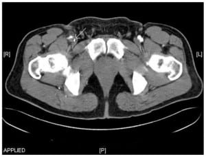 Figure 2. Computed tomography angiogram demonstrating decreased caliber of the right superficial femoral artery as a result of a partial occlusion from a misplaced percutaneous arterial closure device.