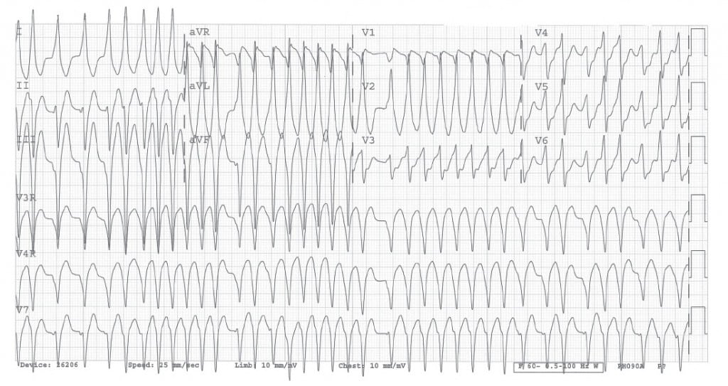 Dolor de Pecho - The Western Journal of Emergency Medicine