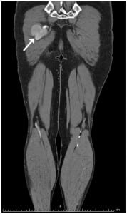 Figure 1. Computed tomography angiogram of lower extremities highlighting extent of left sciatic artery aneurysm and illustrating distal anatomy of the artery.