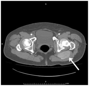 Figure 2. Computed tomography of abdomen/pelvis showing unilateral left sciatic artery aneurysm at its greatest diameters of 7.8 × 4.1 cm.