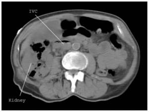 Figure 1. Abdomen computed tomography image without intravenous contrast showing right-sided emphysematous pyelonephritis with an air-fluid level in the inferior vena cava (IVC).