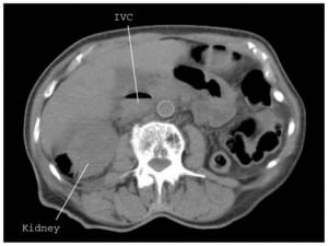 Figure 2. Additional non-contrast computed tomography image highlighting extensive emphysematous pyelonephritis with pneumo-vena cava. IVC signifies inferior vena cava.