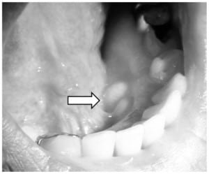 Figure. Two sublingual bony protuberences.