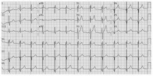 Figure 1. Electrocardiogram revealed an incomplete right bundle branch block with ST elevations in the precordial leads.