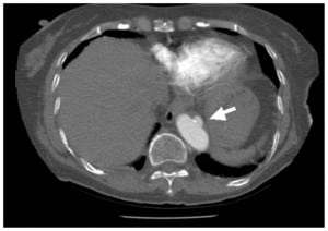 Figure 1. Computed tomography image depicting the lesion in the descending aorta.