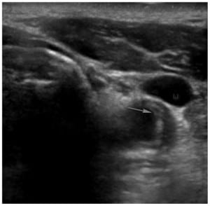 Figure 1. Ultrasound of the common carotid artery showing an intimal flap (IJ) [arrow].