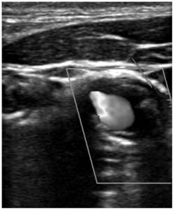 Figure 2. Color Doppler ultrasound (CDUS) showing aliasing, suggesting high velocity flow through narrowed true lumen. Flow is also noted through the false lumen (arrow).